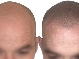Effet crâne rasé